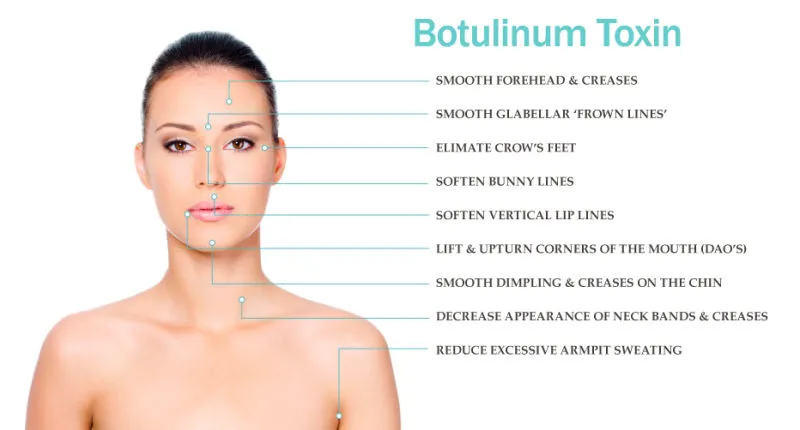 Afslankingsmiddelen Anti-rimpel Beutox Batulaxs Resty Dermal Filler Juvederms 0