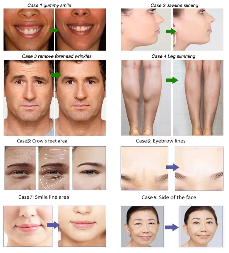 Afslankingsmiddelen Anti-rimpel Beutox Batulaxs Resty Dermal Filler Juvederms 1